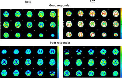 Association between cerebrovasoreactivity and stroke in cerebral autosomal dominant arteriopathy with subcortical infarcts and leukoencephalopathy